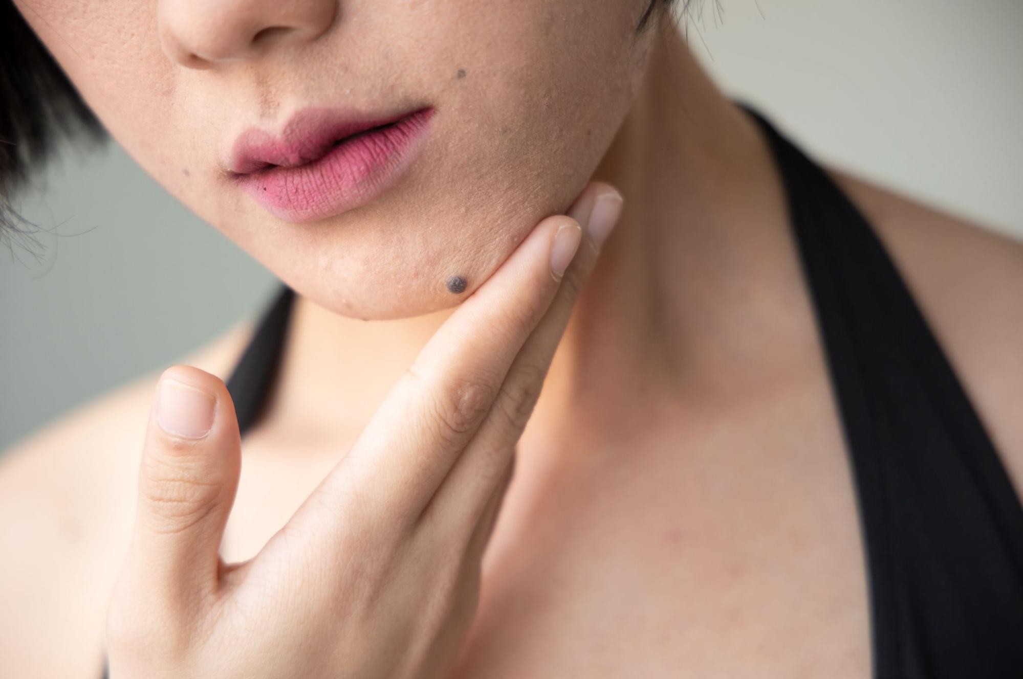 毛穴トラブルの種類