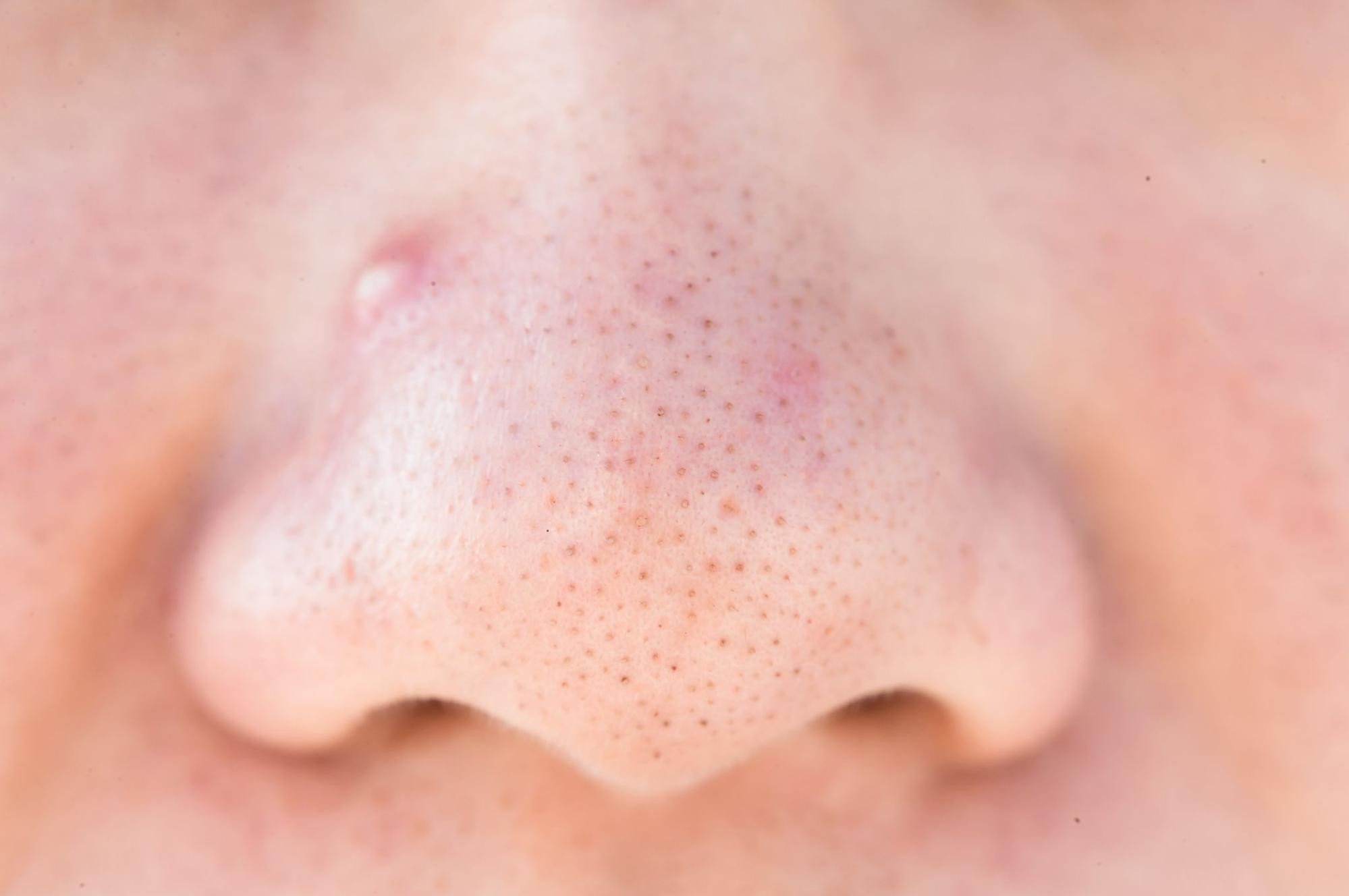 毛穴トラブルは皮膚科へ行くべき?おすすめ治療やセルフケア方法も解説