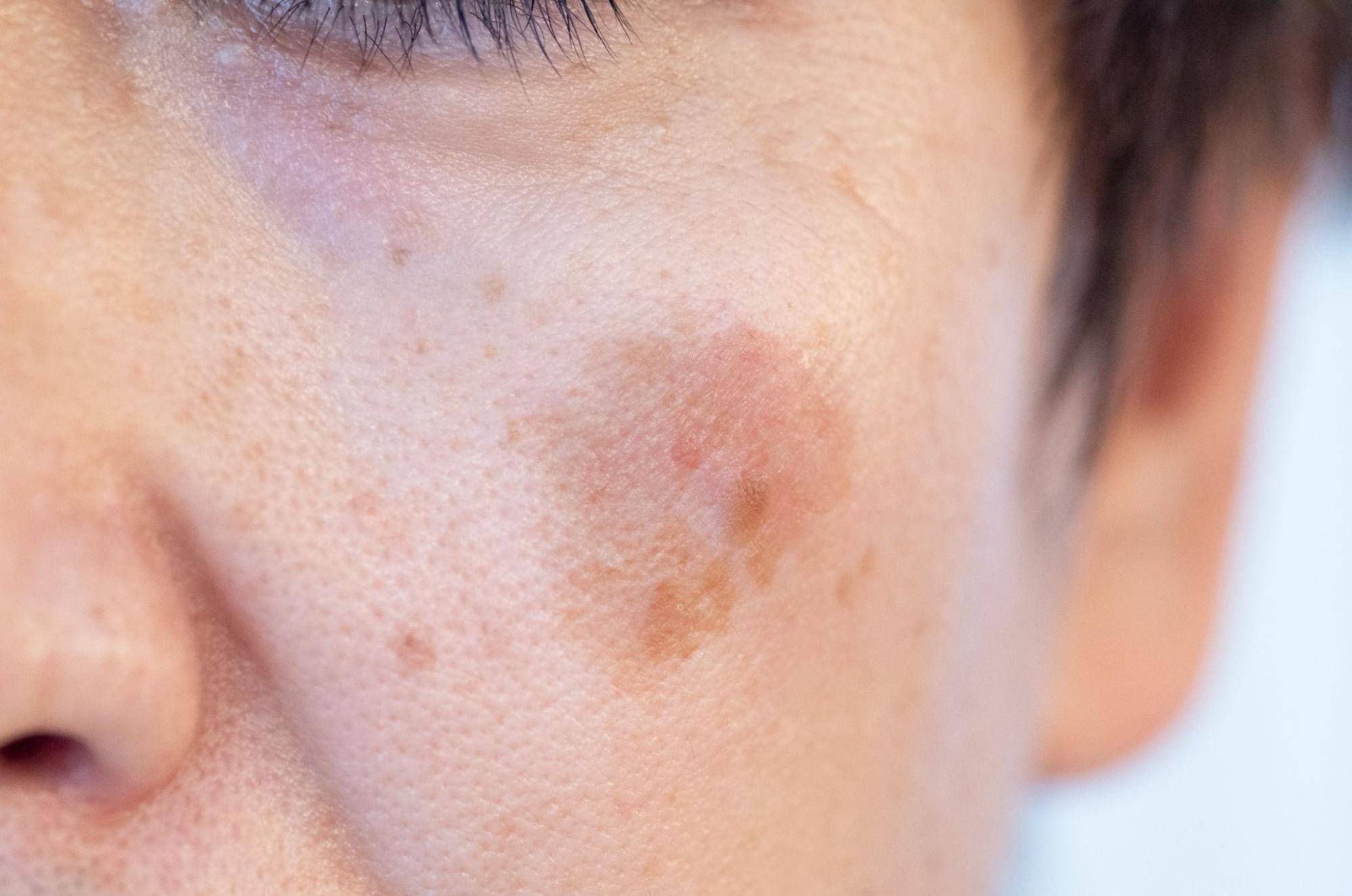 シミ取りレーザーができない人って?理由や治療の種類について解説